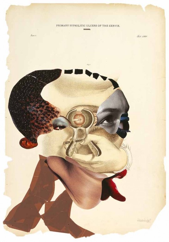 Wangechi Mutu, Primary syphilitic ulcers of the cervix
